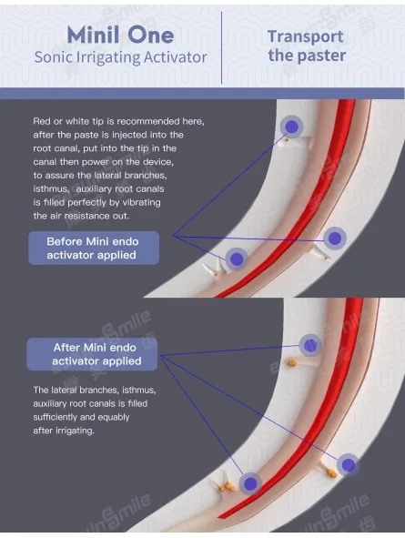 easyinsmile-endodontic-easydo-endo-activator-oral-mini-sonic-irrigator-with-45pc-soft-tips-dental-equipment- (3).webp