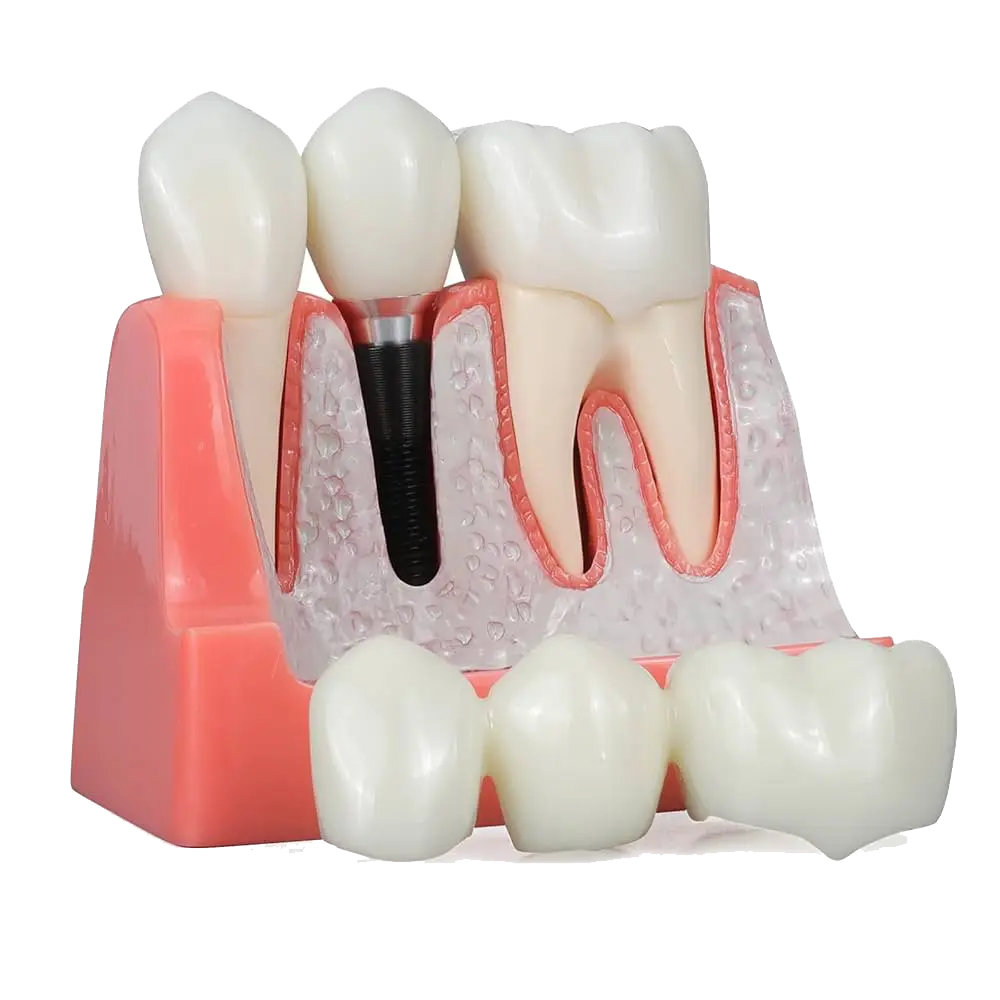 موديل اسنان زرعات  IMPLANT moniqan