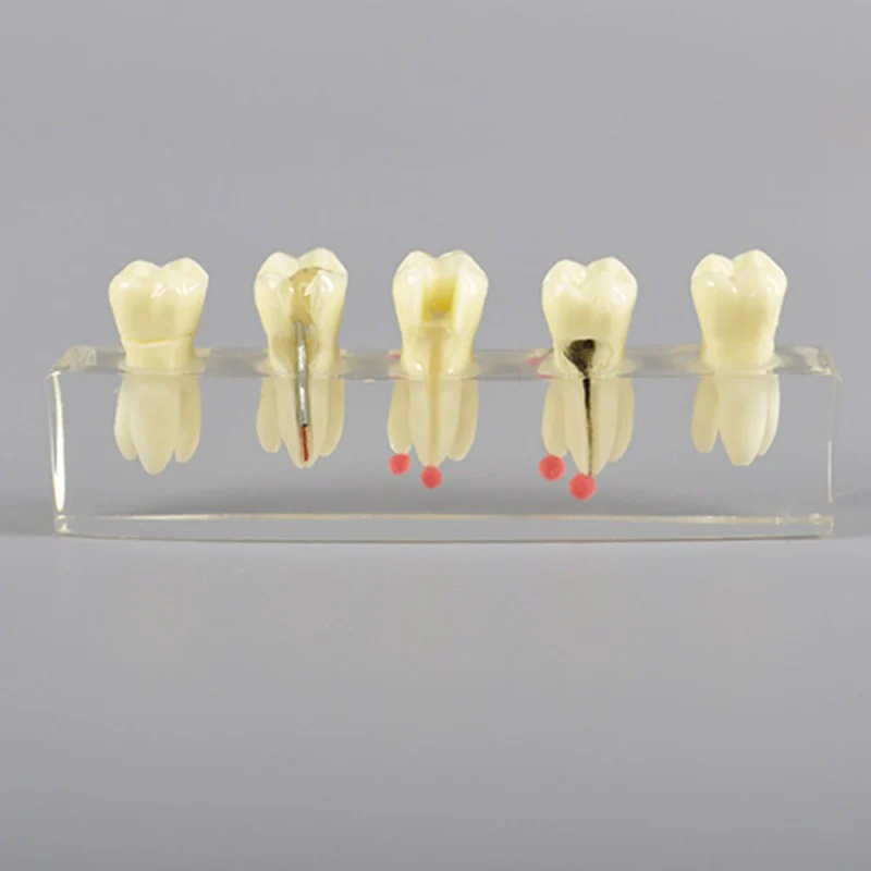 W4012 Dental Root Canal Model with Restoration ‏ موديل