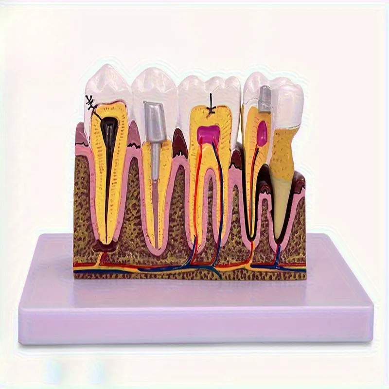 [7100000000RCTM] Root Canal Treatment Model‏
 موديل